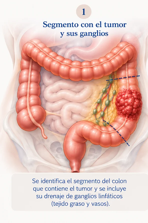 Paso 1 de la cirugía de cáncer de colon