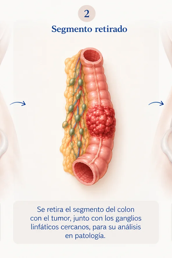 Paso 2 de la cirugía de cáncer de colon
