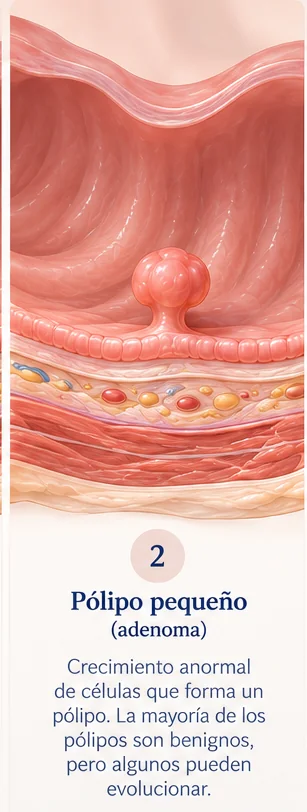 Paso 2 de la progresión de pólipo a cáncer de colon