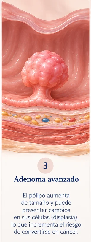 Paso 3 de la progresión de pólipo a cáncer de colon