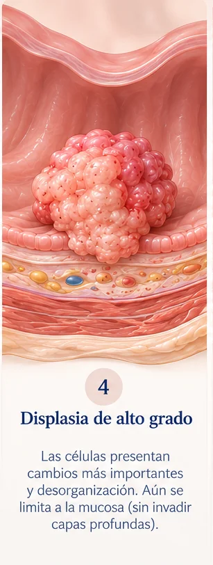 Paso 4 de la progresión de pólipo a cáncer de colon