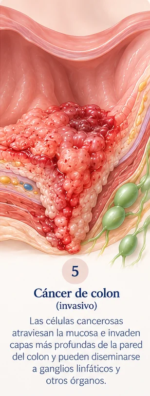 Paso 5 de la progresión de pólipo a cáncer de colon
