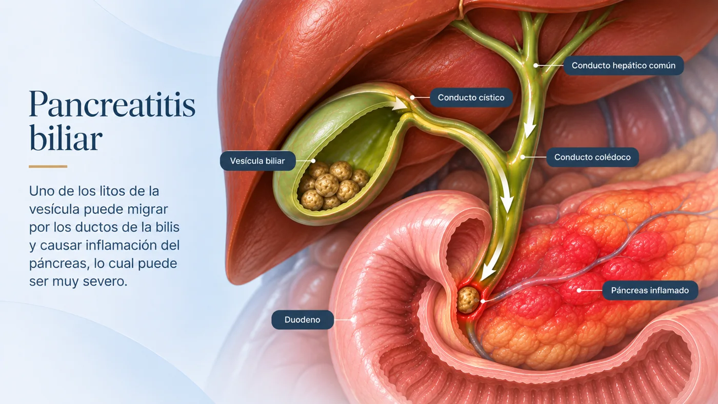 Pancreatitis biliar: un cálculo migra por los conductos de la bilis y causa inflamación del páncreas, que puede ser muy severa