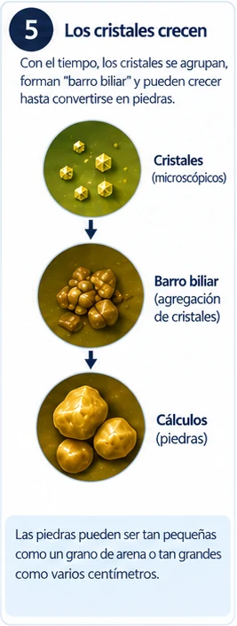 Paso 5: Barro biliar y piedras. Con el tiempo, los cristales se agrupan, forman “barro biliar” y crecen hasta convertirse en piedras.
