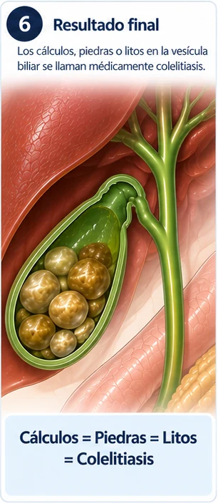 Paso 6: Resultado: colelitiasis. Las piedras pueden medir desde un grano de arena hasta varios centímetros. Cálculos = piedras = litos = colelitiasis.